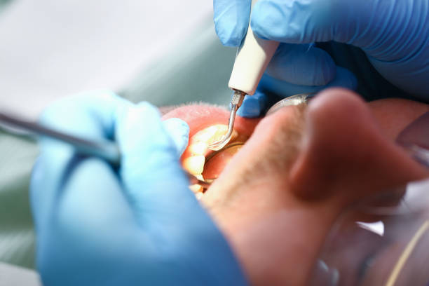 Best Emergency Dental Care for Abscessed Tooth in Weston, MO